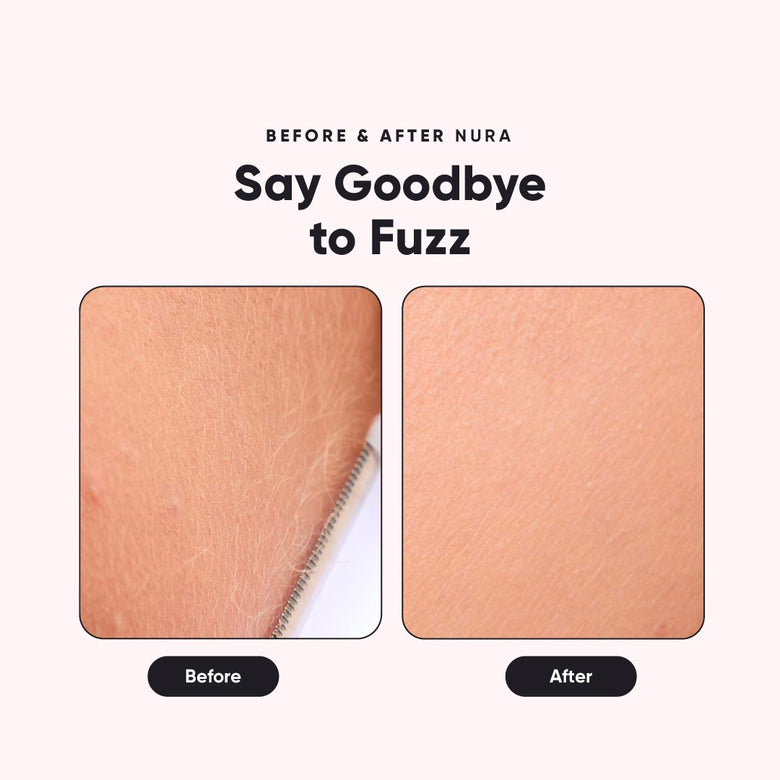 Nura - Sonic Dermaplaner